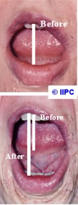 1-Before-and-After-Mouth-Scar-Relaxation-115x300